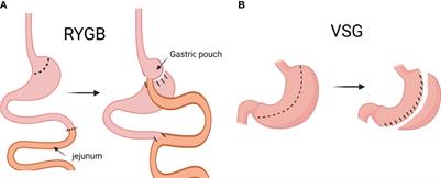 Bile acids, gut microbiota and metabolic surgery